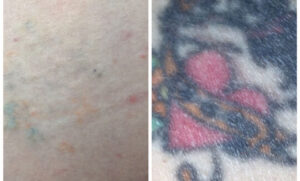 Before and After 4 sessions Renude Laser 1 540x326 1