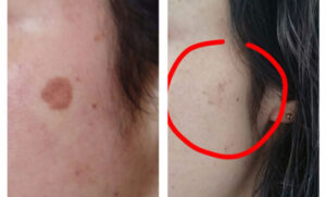 Before and After Pigment 2 sessions Renude Laser 1 540x326 1