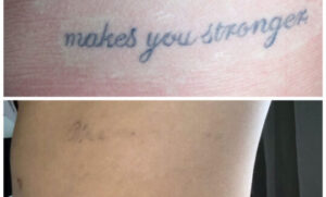 Before and After Tattoo Removal Renude Laser 2 540x326 1