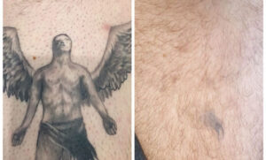 Before and After Tattoo Removal Renude Laser 3 540x326 1