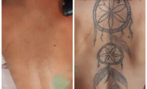 Before and After Tattoo Removal Renude Laser 4 540x326 1
