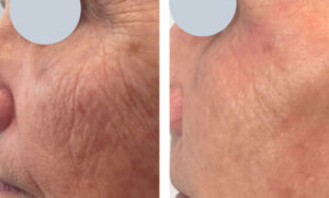 Before and After skin tightining Renude Laser 540x326 1