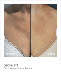 Decollete Before and After