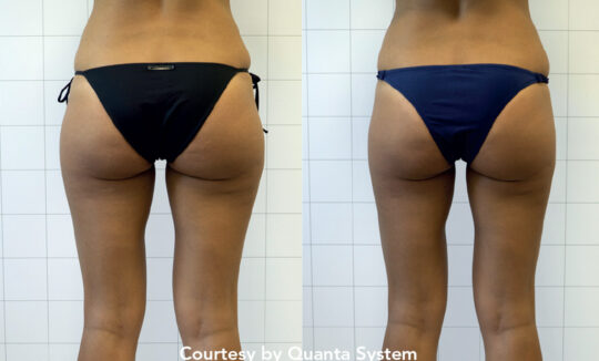 Delinea Before and Afters Buttocks 540x326 1