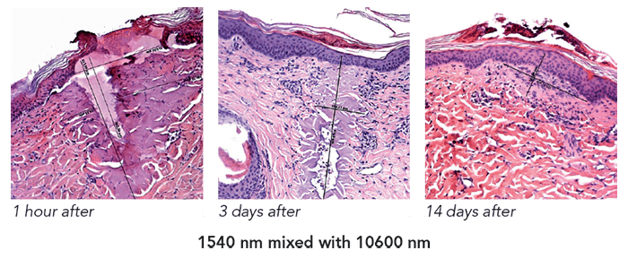 Histology after using Youlaser MT Mixed Technology