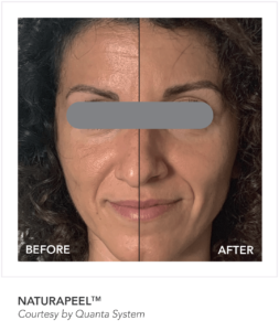 NaturaPeel Before and After