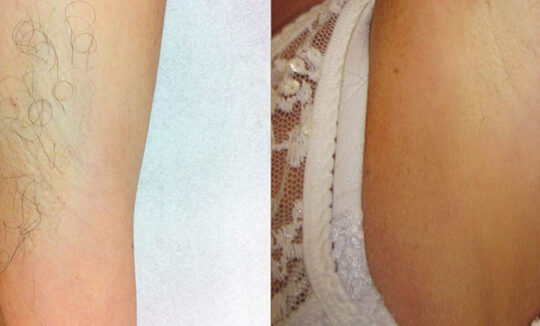 Quanta System Duetto MT EVO Hair Removal Before and After 540x326 1