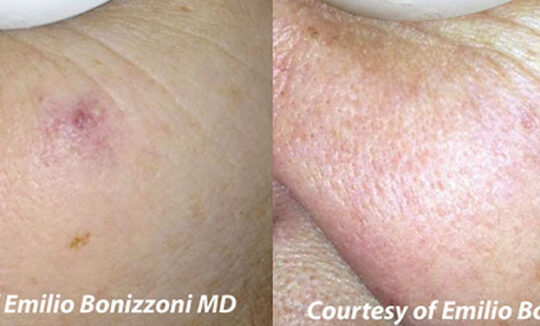 Quanta System Duetto MT EVO Vascular Lesion Before and After Emilio Bonizzoni MD 540x326 1