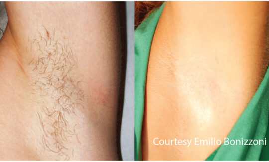 Quanta System Light EVO Series Before and After Hair Removal Treatment Emilio Bonizzoni MD 540x326 1