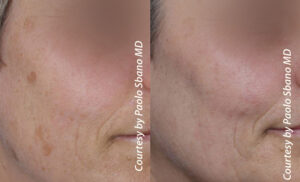 Quanta System Q Plus C EVO MT Benign Pigmented Lesions Before and After Paolo Sbano MD