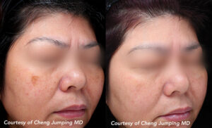 Quanta System Q Plus EVO Benign Pigmented Lesions Before and After