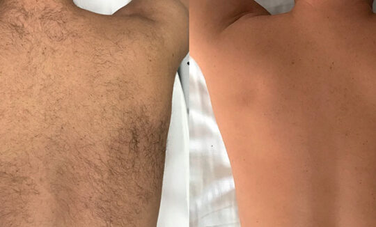 Quanta System Thunder Back Hair Removal Before and Afters 540x326 1