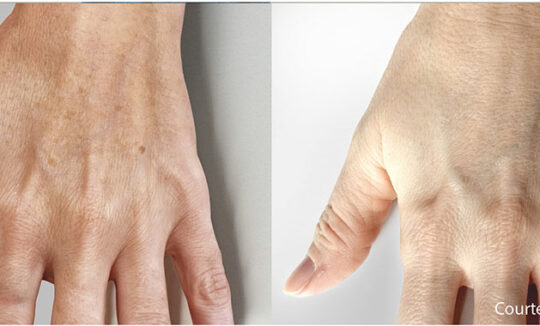 Quanta System Thunder Hand Pigmented Lesions Before and Afters Paolo Sbano MD 540x326 1