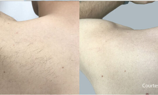 Quanta System Thunder Men Shoulders Hair Removal Before and Afters 540x326 1