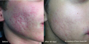 Quanta System Youlaser MT Before and After Acne Scar Treatment Paolo Sbano MD