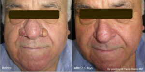 Quanta System Youlaser MT Before and After Rhinophyma Treatment Paolo Sbano MD