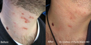Quanta System Youlaser MT Before and After Scar Treatment Paolo Sbano MD