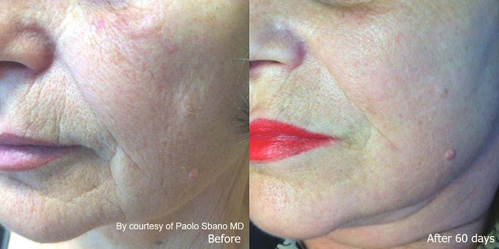 Quanta System Youlaser MT Before and After Skin Resurfacing Paolo Sbano MD